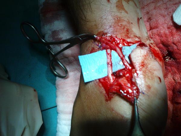 MİKROCERRAHİ NEDİR