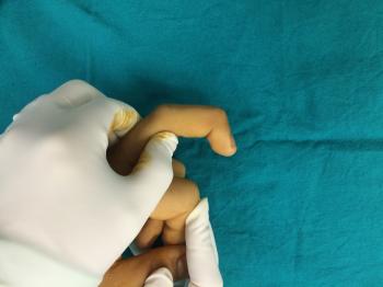 çekiç parmak deformitesi ( mallet finger)